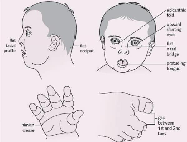 18 Down Syndrome Facts - Signs, Causes, Treatment & More - Facts.net