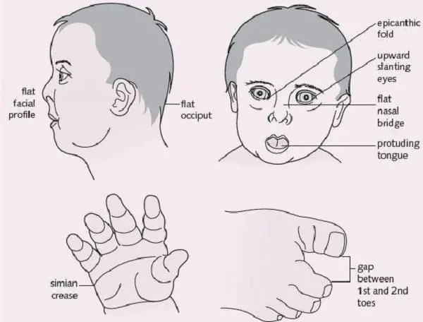 18 Down Syndrome Facts Signs Causes Treatment More Facts Net   Down Syndrome Symptoms 