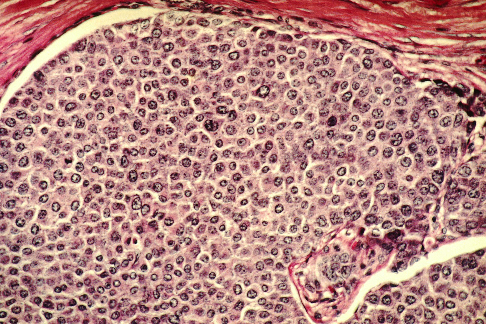 Watermelon Facts, Breast Cancer Cells