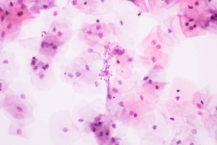 View in microscopic of Candidiasis, fungus infection