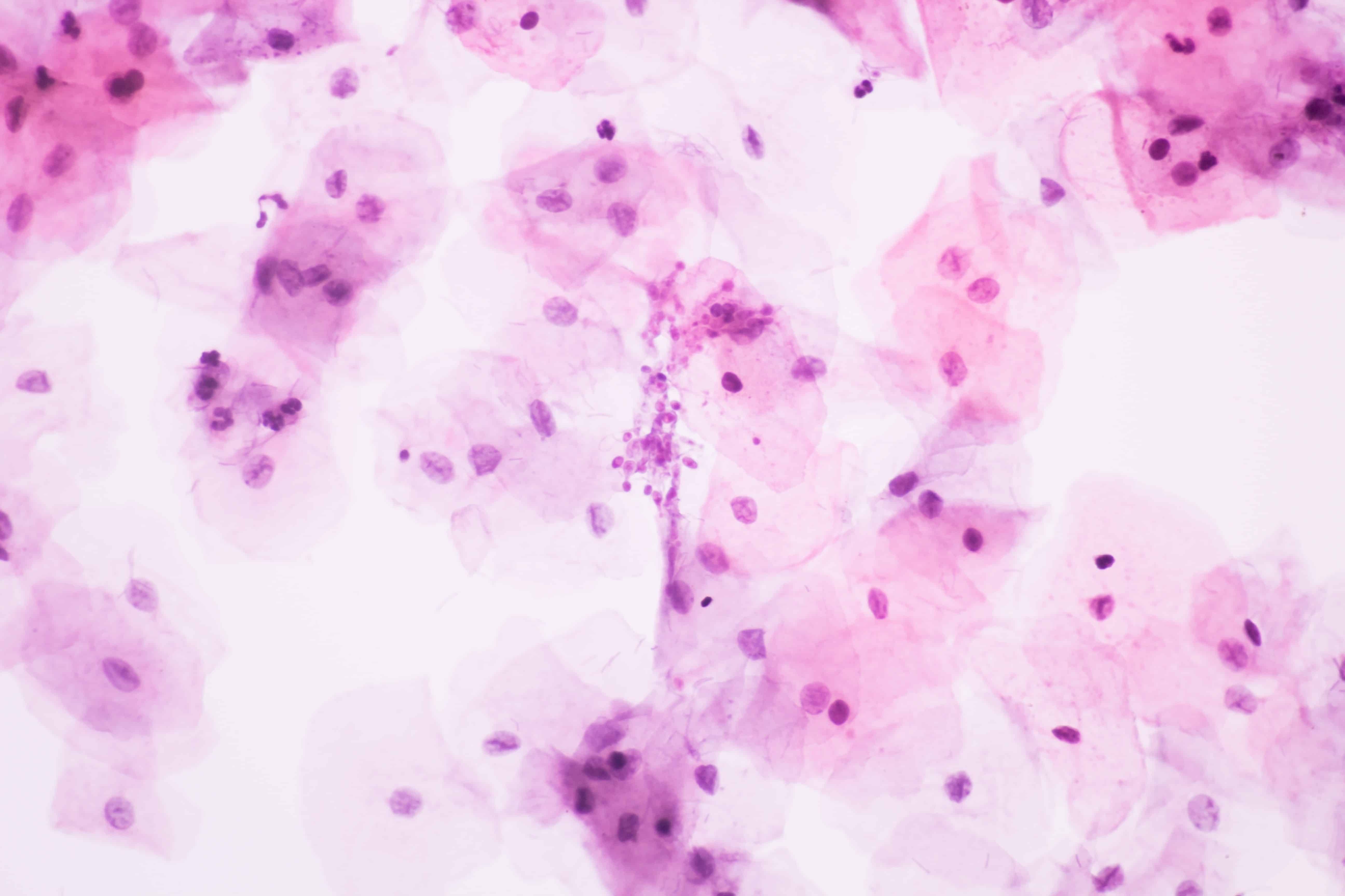 UTI vs Yeast Infections What's the Difference?