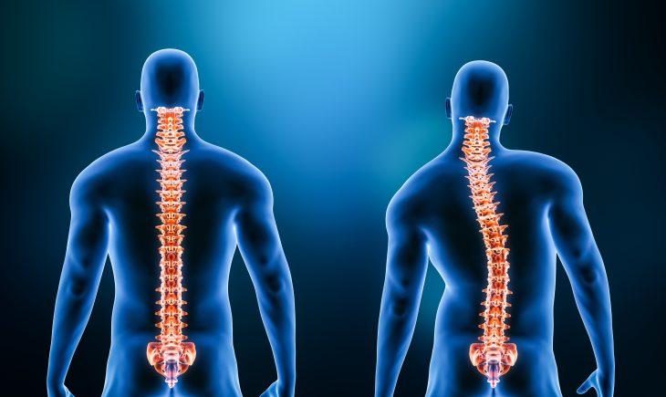 Comparison between normal backbone and scoliosis curvature of the spine