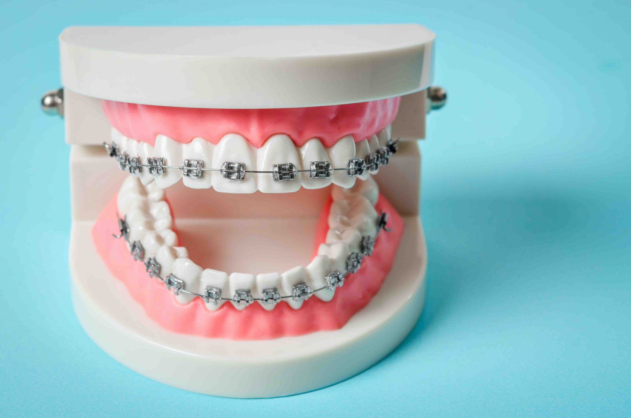 11 Facts About Braces - Facts.net