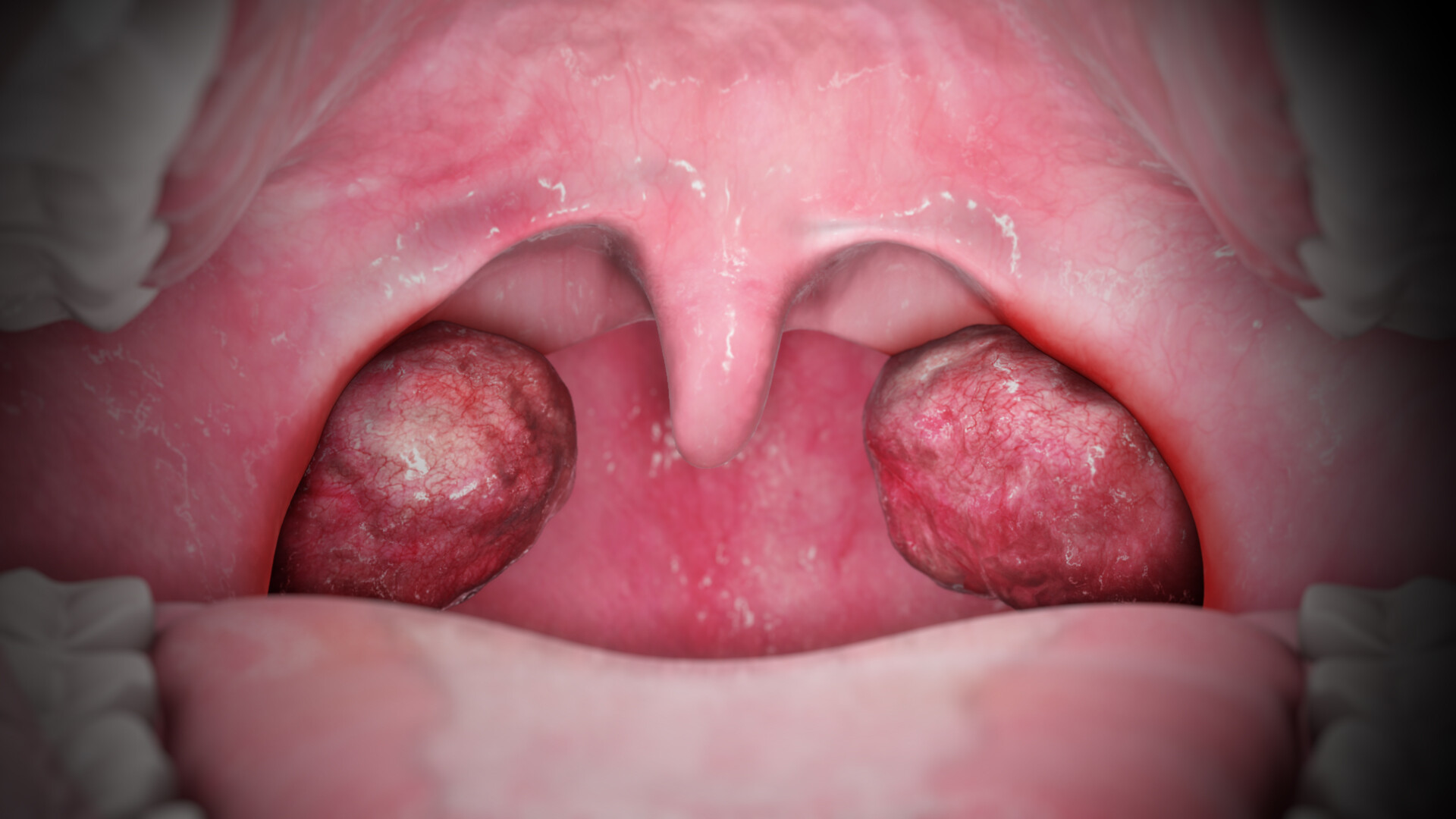 11-astounding-facts-about-tonsils-palatine-tonsil