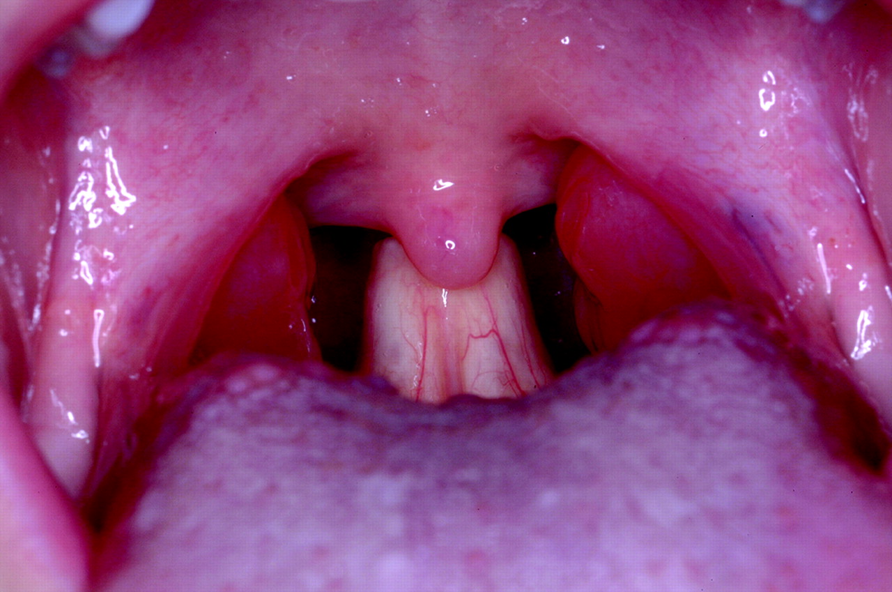 14-fascinating-facts-about-epiglottis