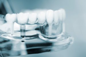 Immediate Dental Implants Are They Better Than Traditional Implants