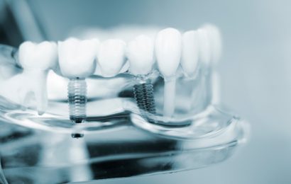 Immediate Dental Implants Are They Better Than Traditional Implants