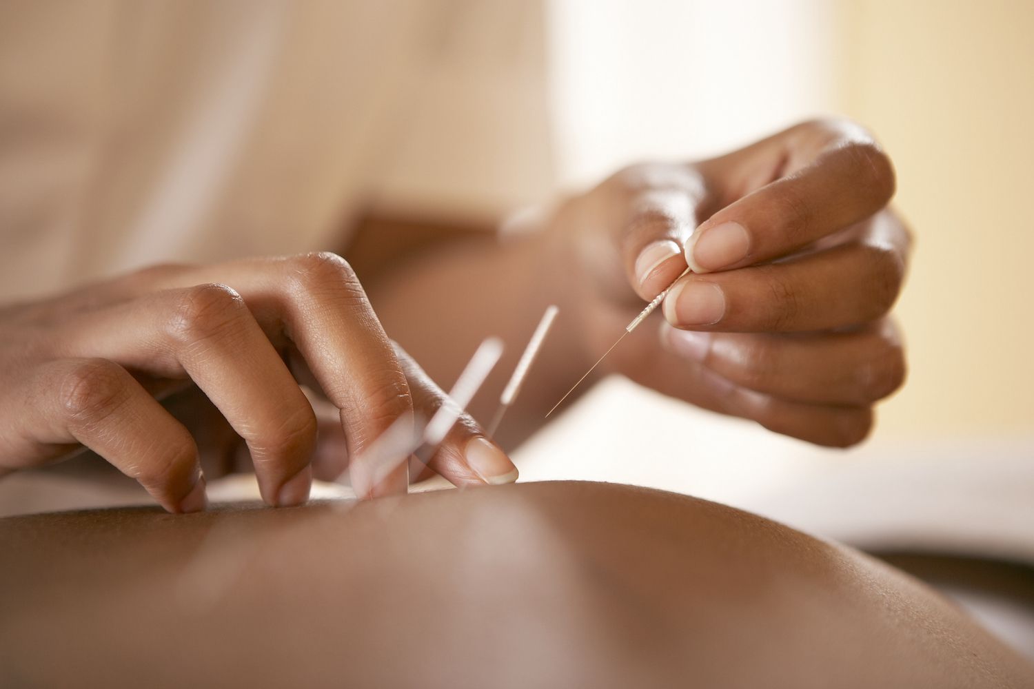 8-captivating-facts-about-acupuncturist