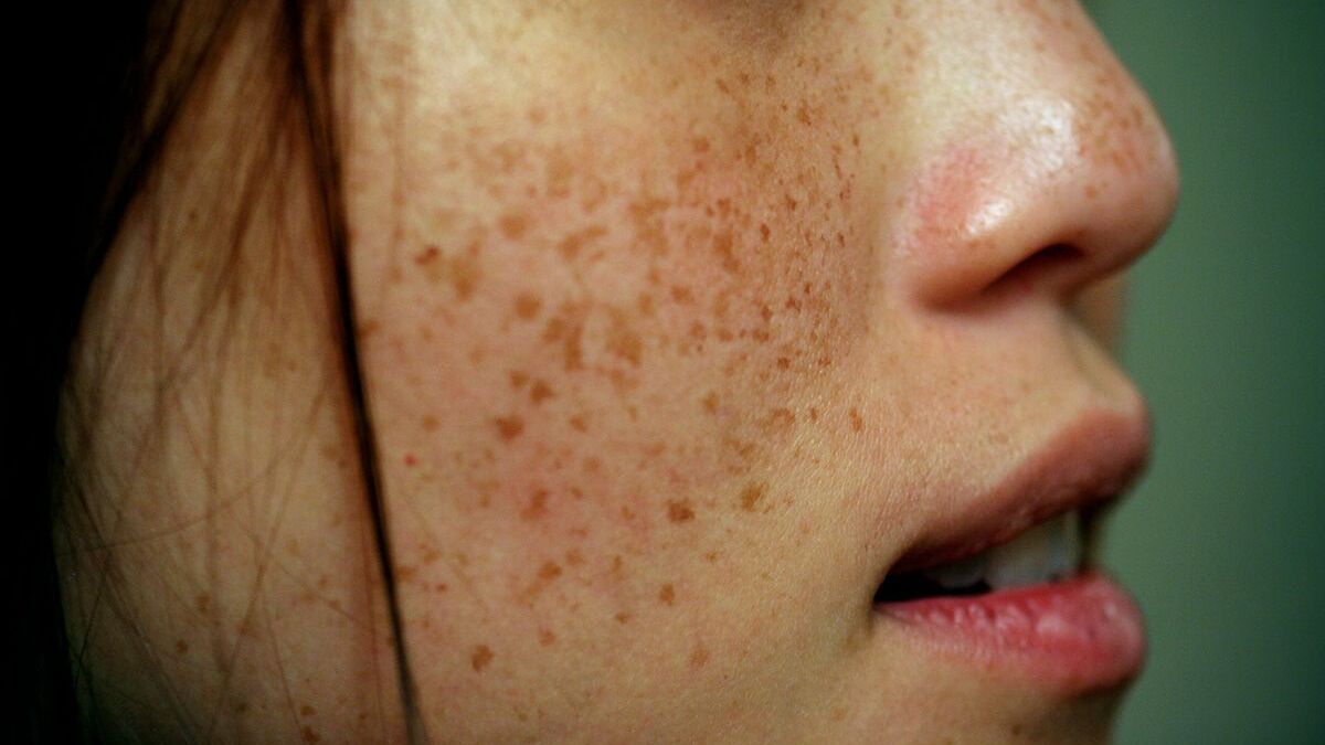 10-fun-facts-about-freckles
