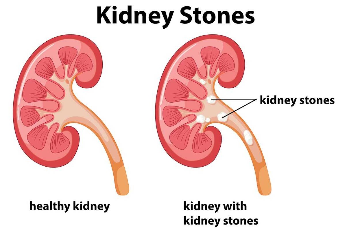 10-fun-facts-about-kidney-stones
