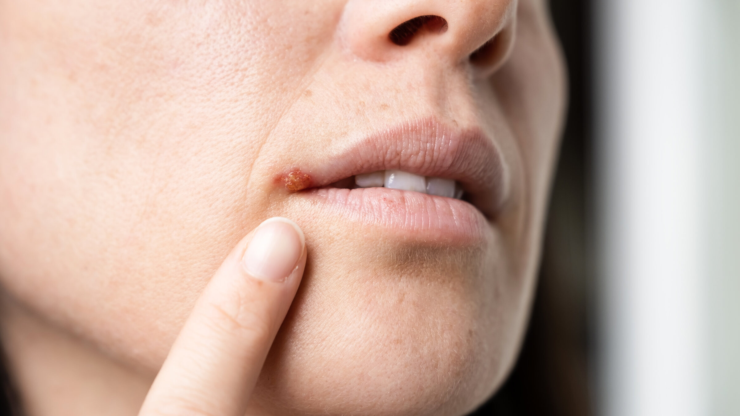10-interesting-facts-about-cold-sores