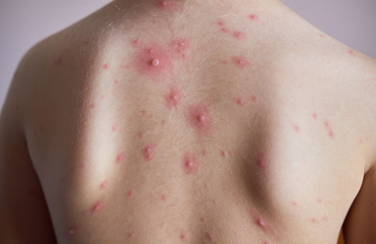 11-chicken-pox-facts-and-myths