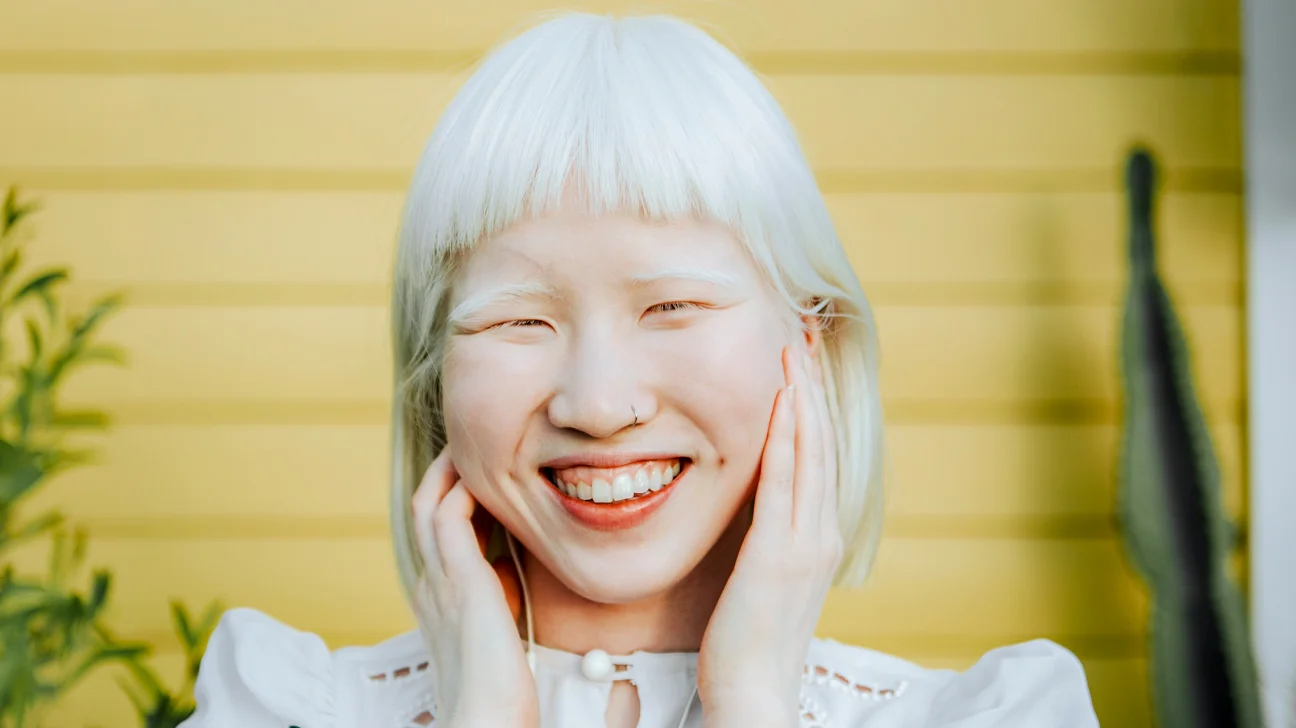 11-fun-facts-about-albinism