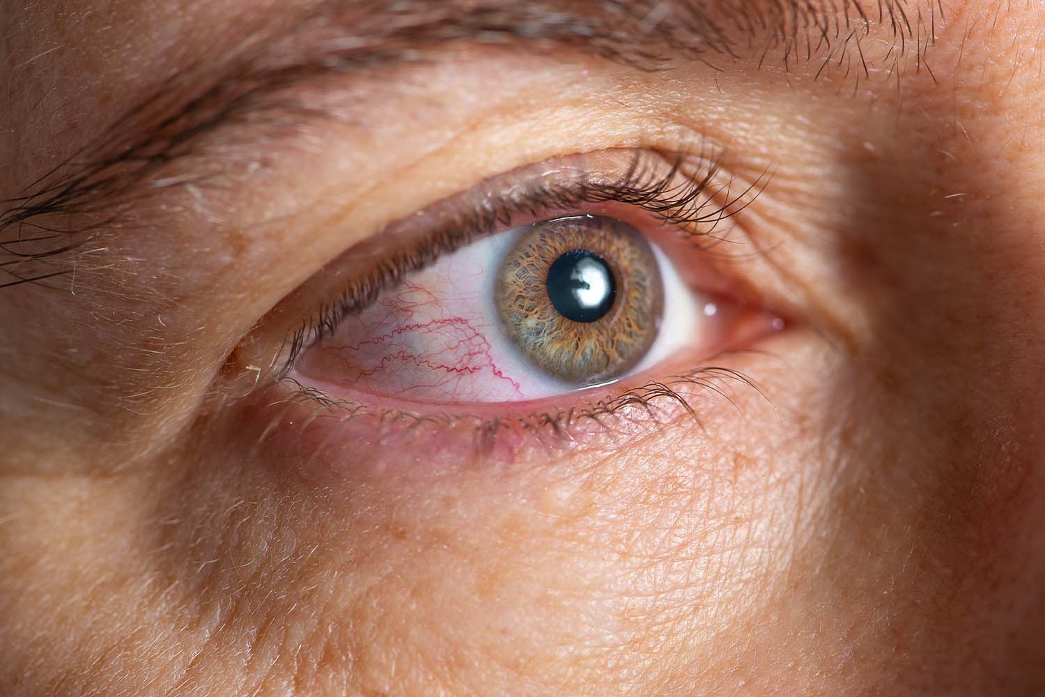 11-interesting-facts-about-pink-eye