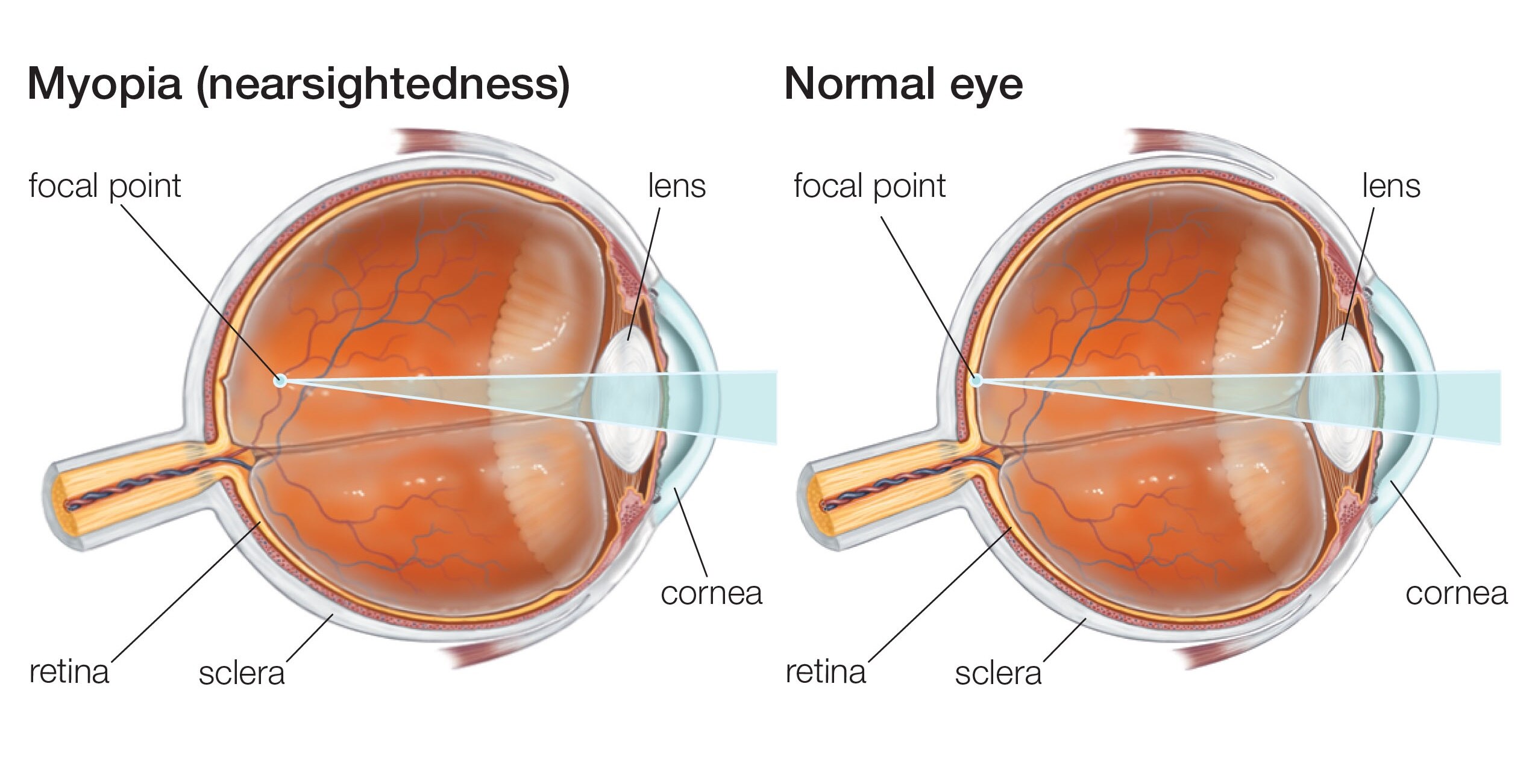 Пропадает зрение на одном глазу. Строение глаза при миопии высокой степени. Дальнозоркость и близорукость строение глаза. Анатомия глаза близорукость и дальнозоркость. Сложный гиперметропический астигматизм 1 степени.