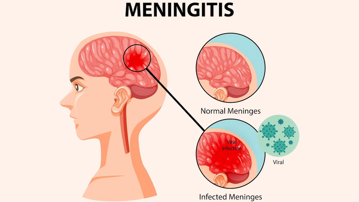15-interesting-facts-about-meningitis