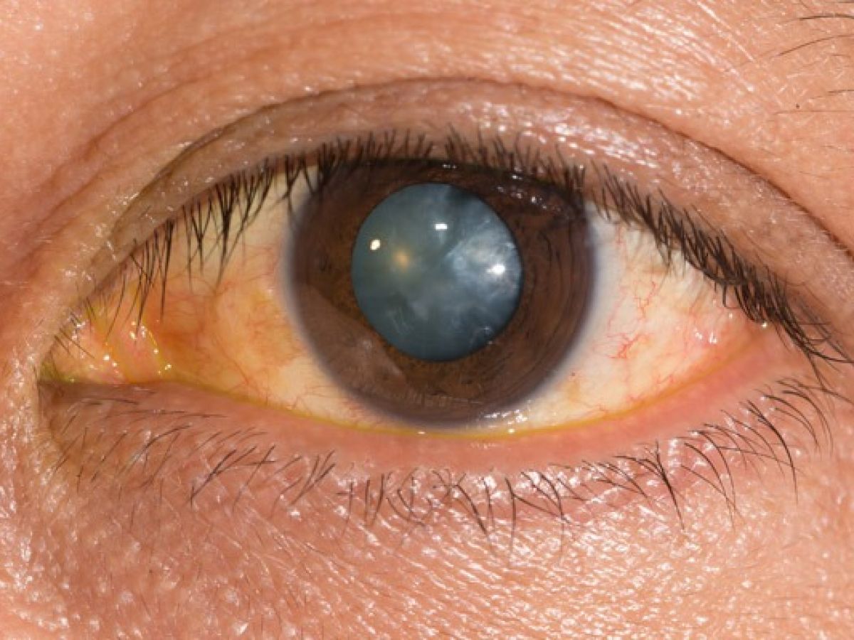 18-facts-about-cataracts