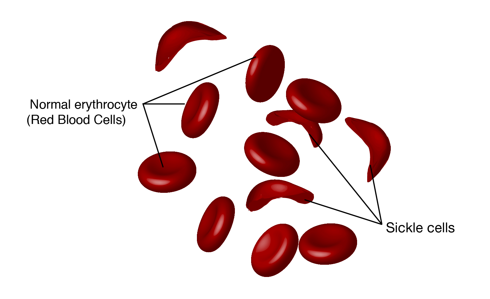 18-interesting-facts-about-sickle-cell-disease