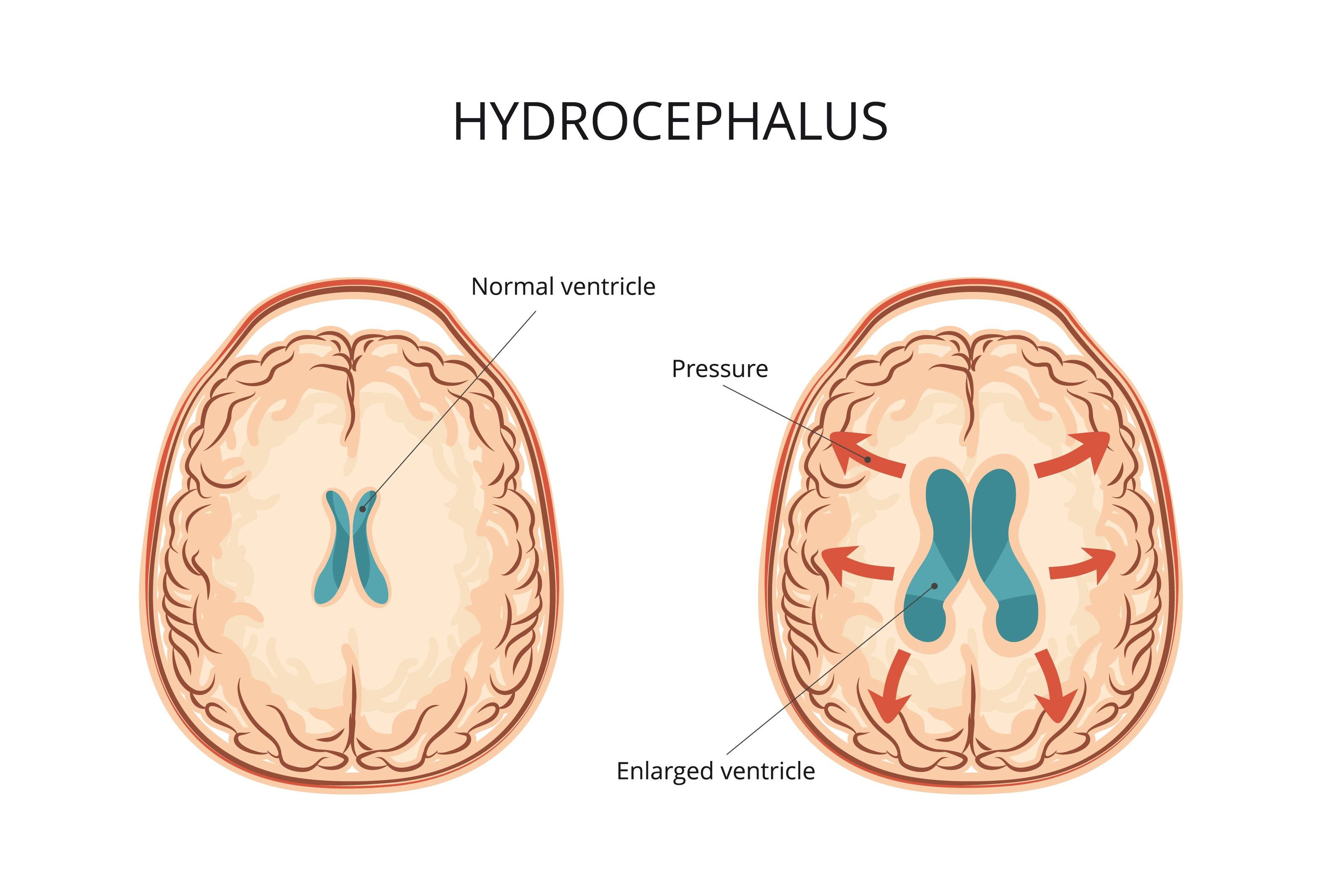 19-facts-about-hydrocephalus