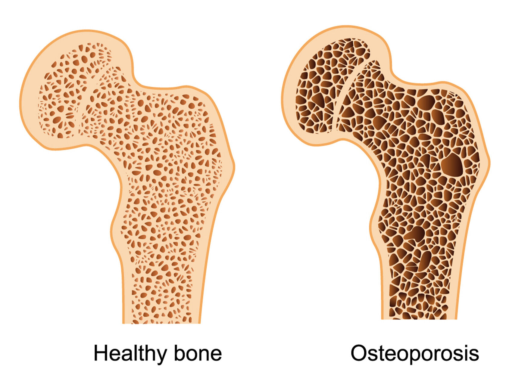20-interesting-facts-about-osteoporosis