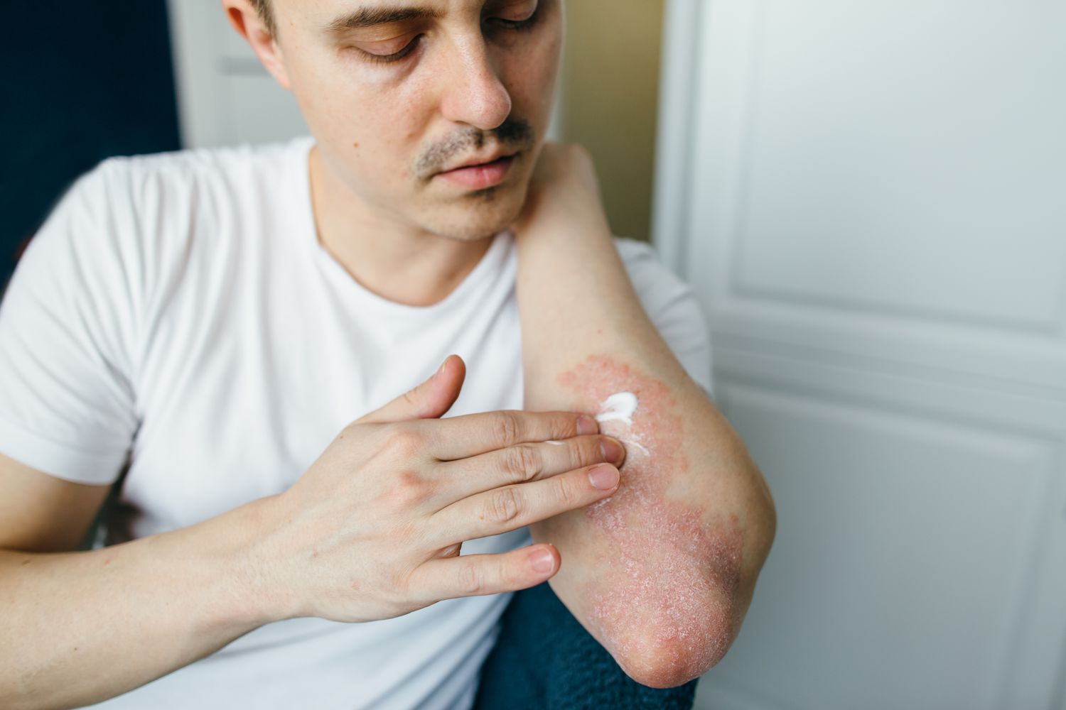 8-facts-you-must-know-about-dermatitis-creams