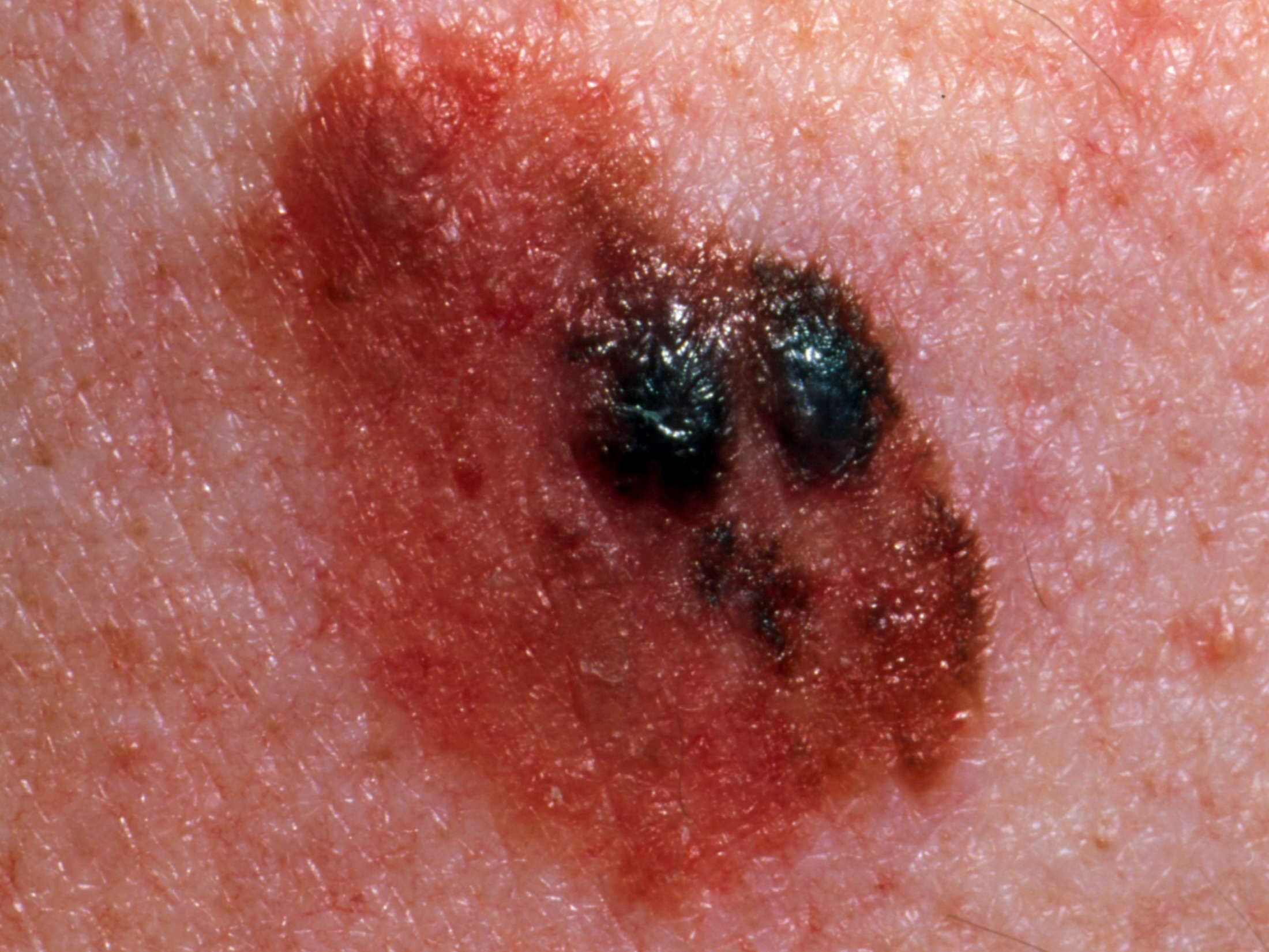 13-facts-about-melanoma-death-rate-by-age