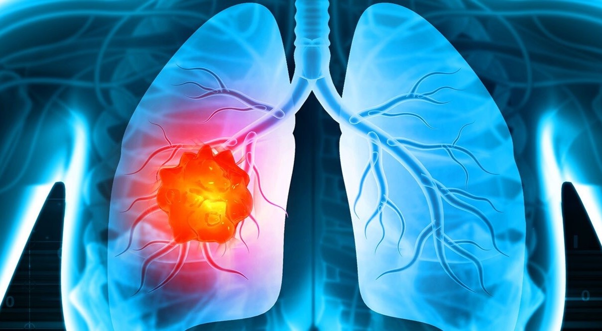 14-facts-about-lung-cancer
