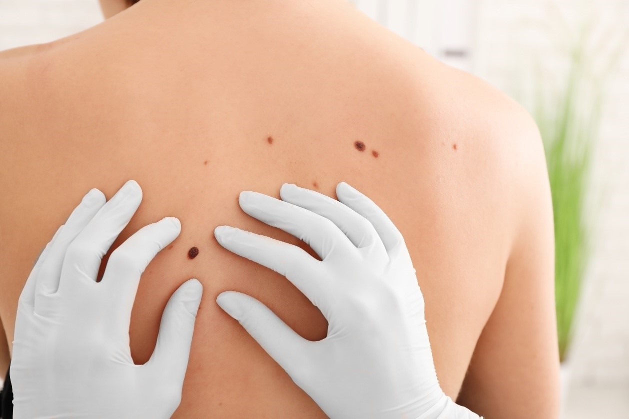 14-facts-about-skin-cancer-statistics