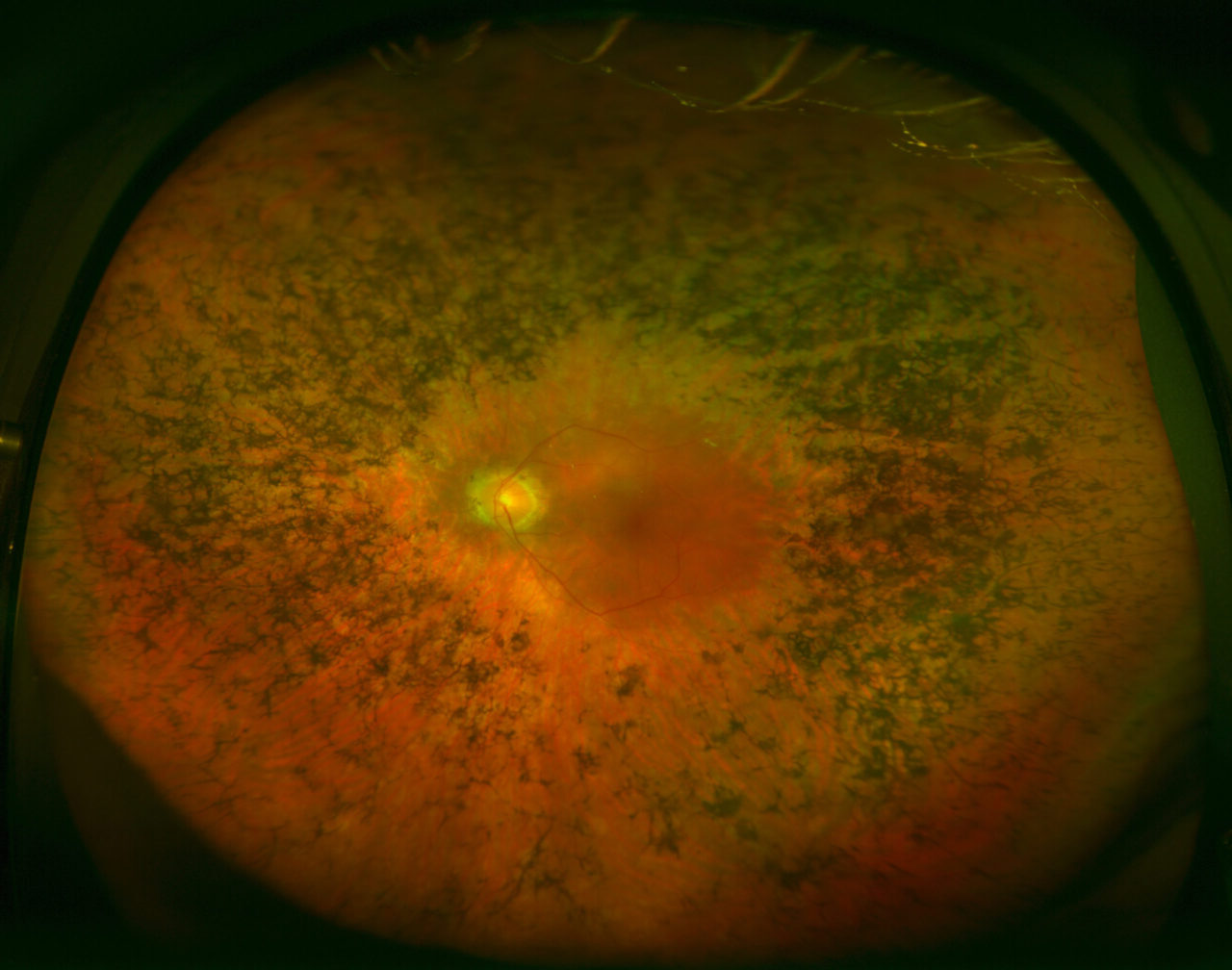 14-great-interesting-facts-about-retinitis-pigmentosa