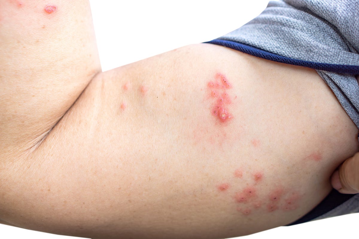 24-best-facts-about-shingles
