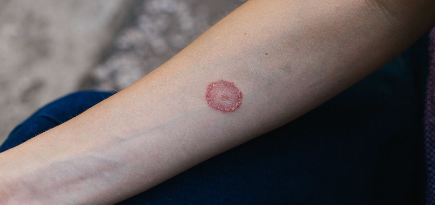 29 Amazing Facts About Ringworm - Facts.net