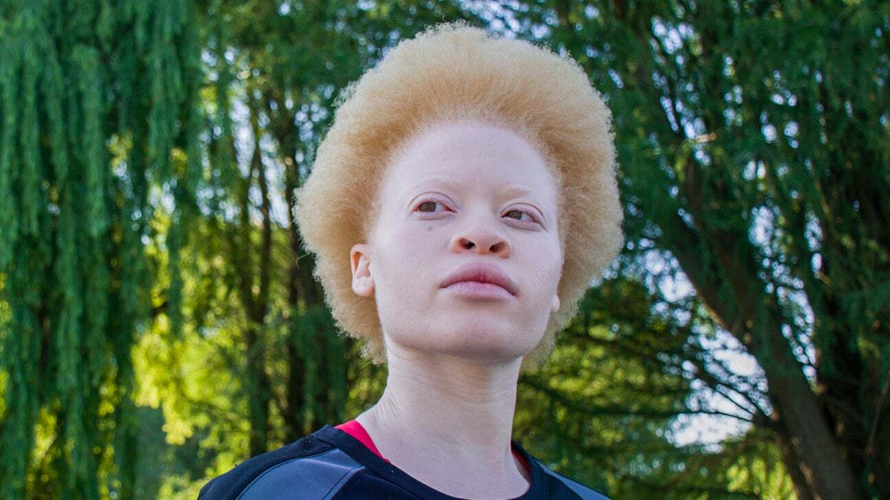 12-facts-about-albino-people