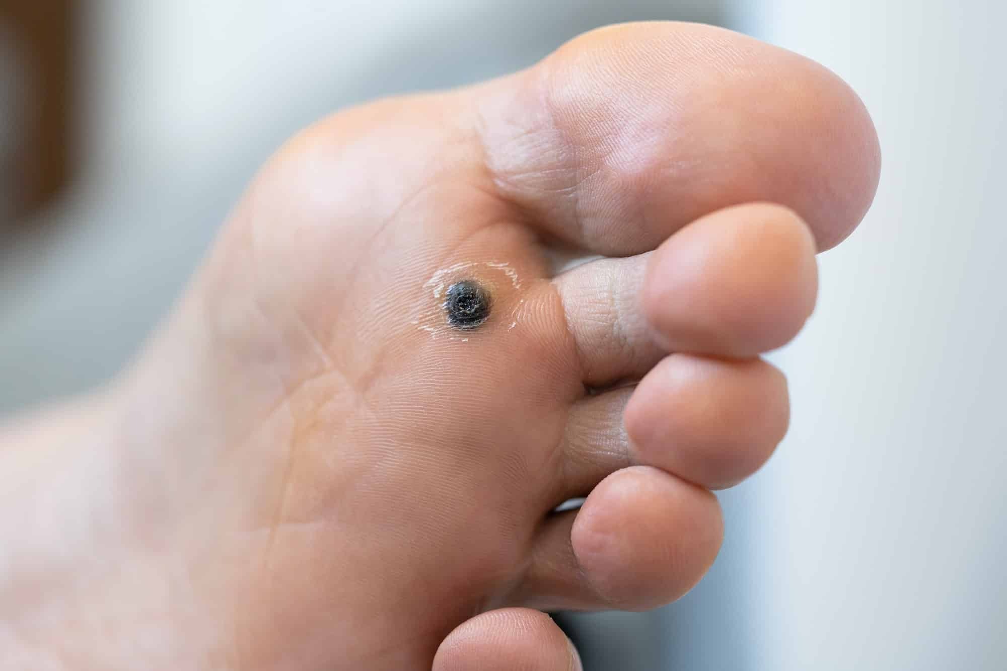 12-facts-about-plantar-wart
