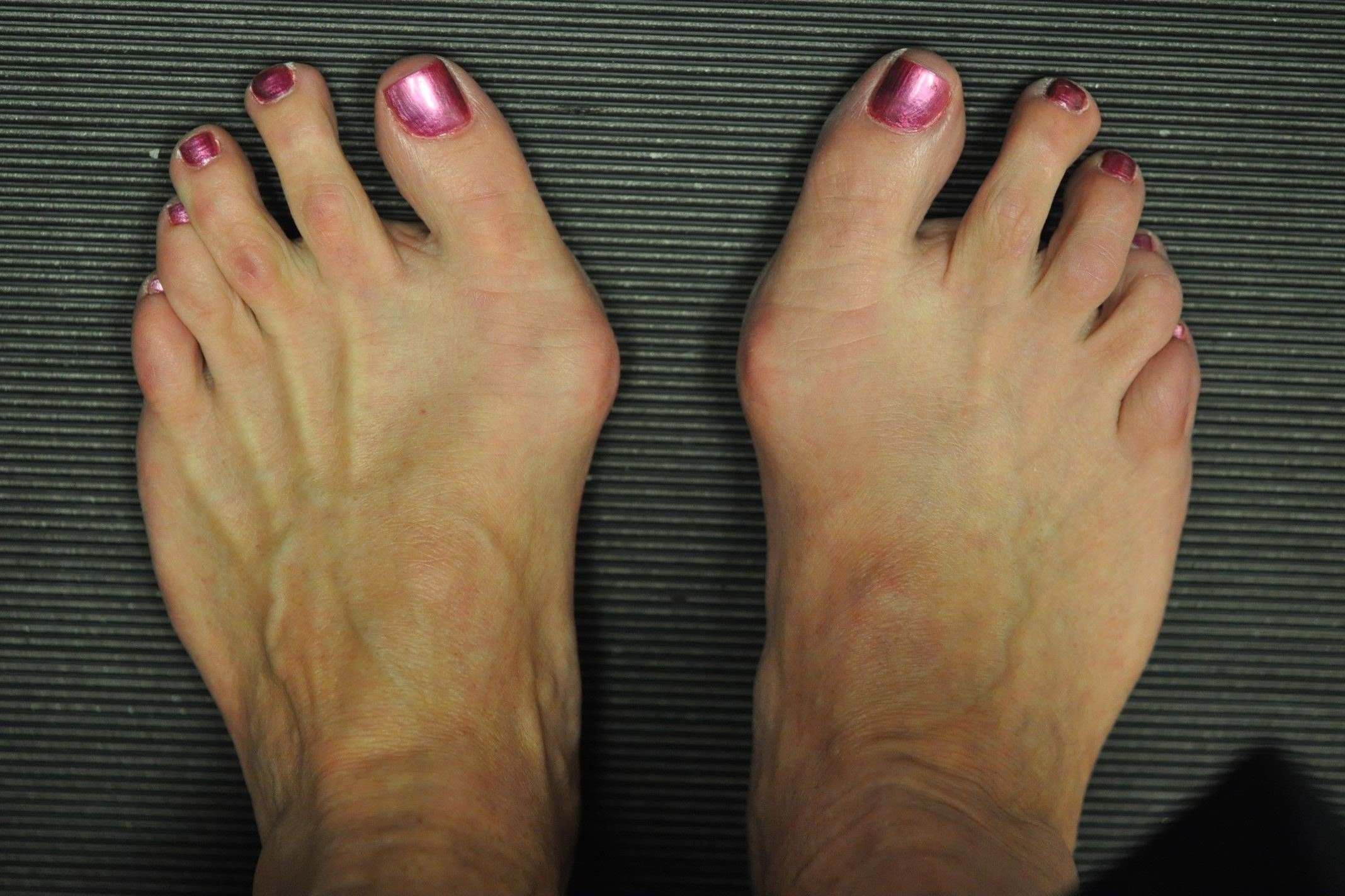 13-facts-about-bunion