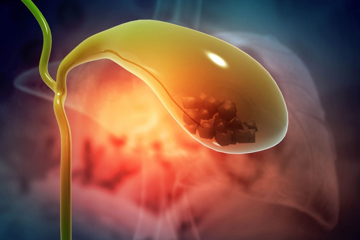 13-facts-about-gallbladder-stones