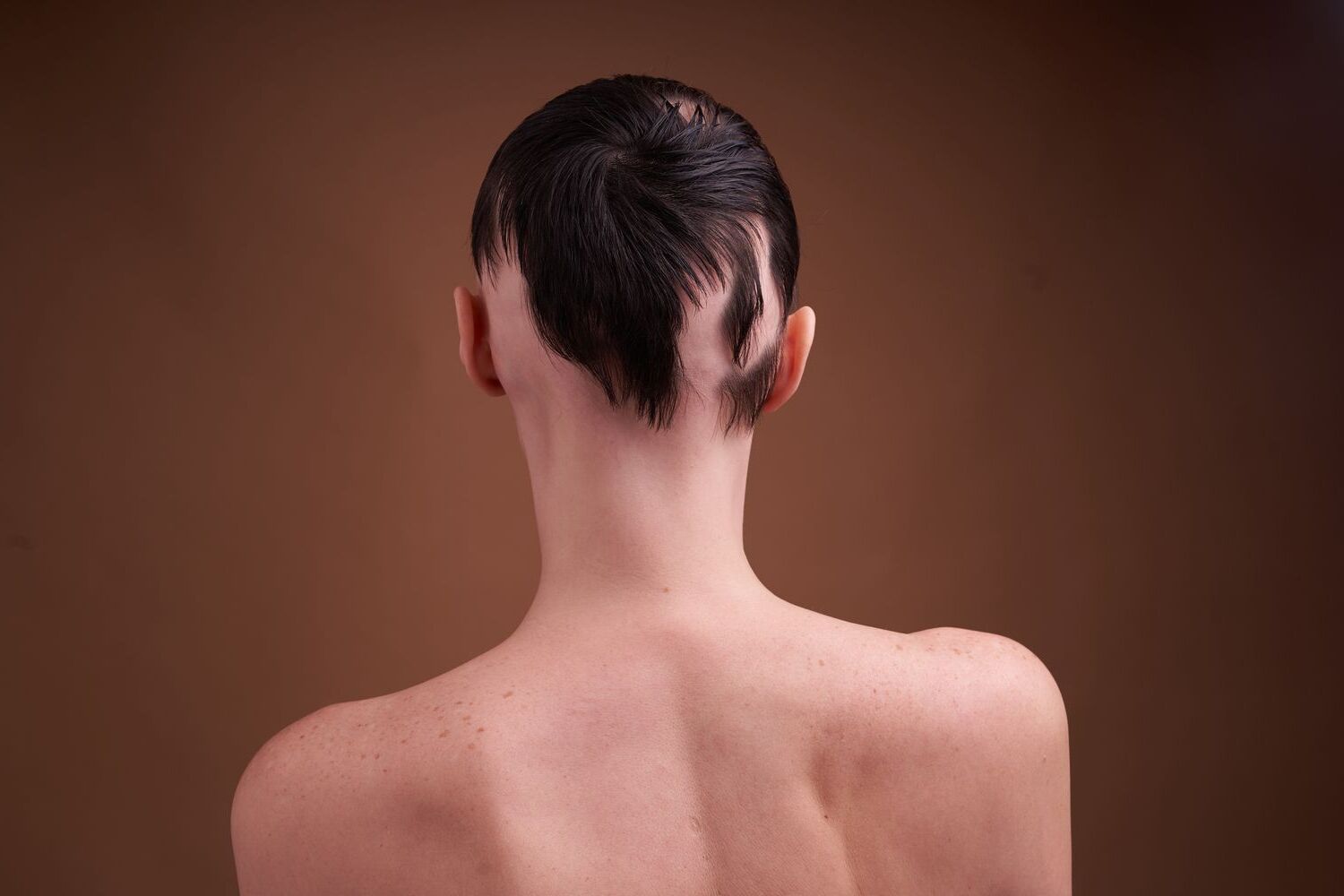 14-facts-about-alopecia-areata