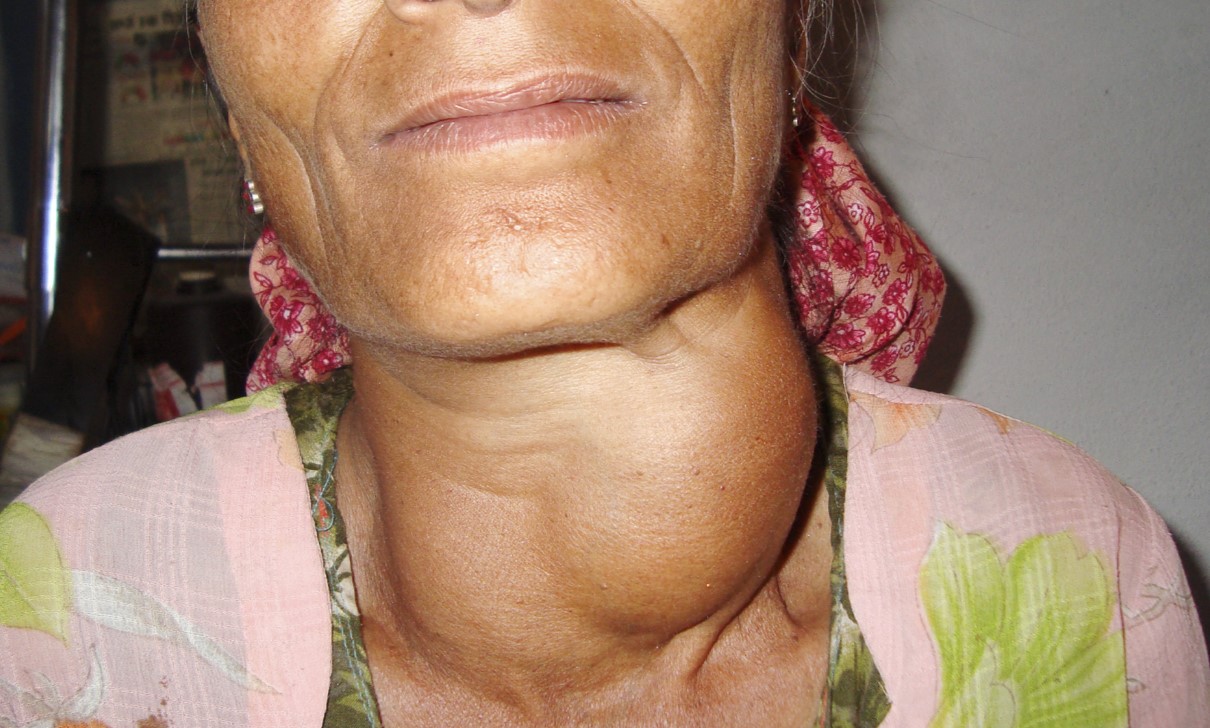 14-facts-about-goiter