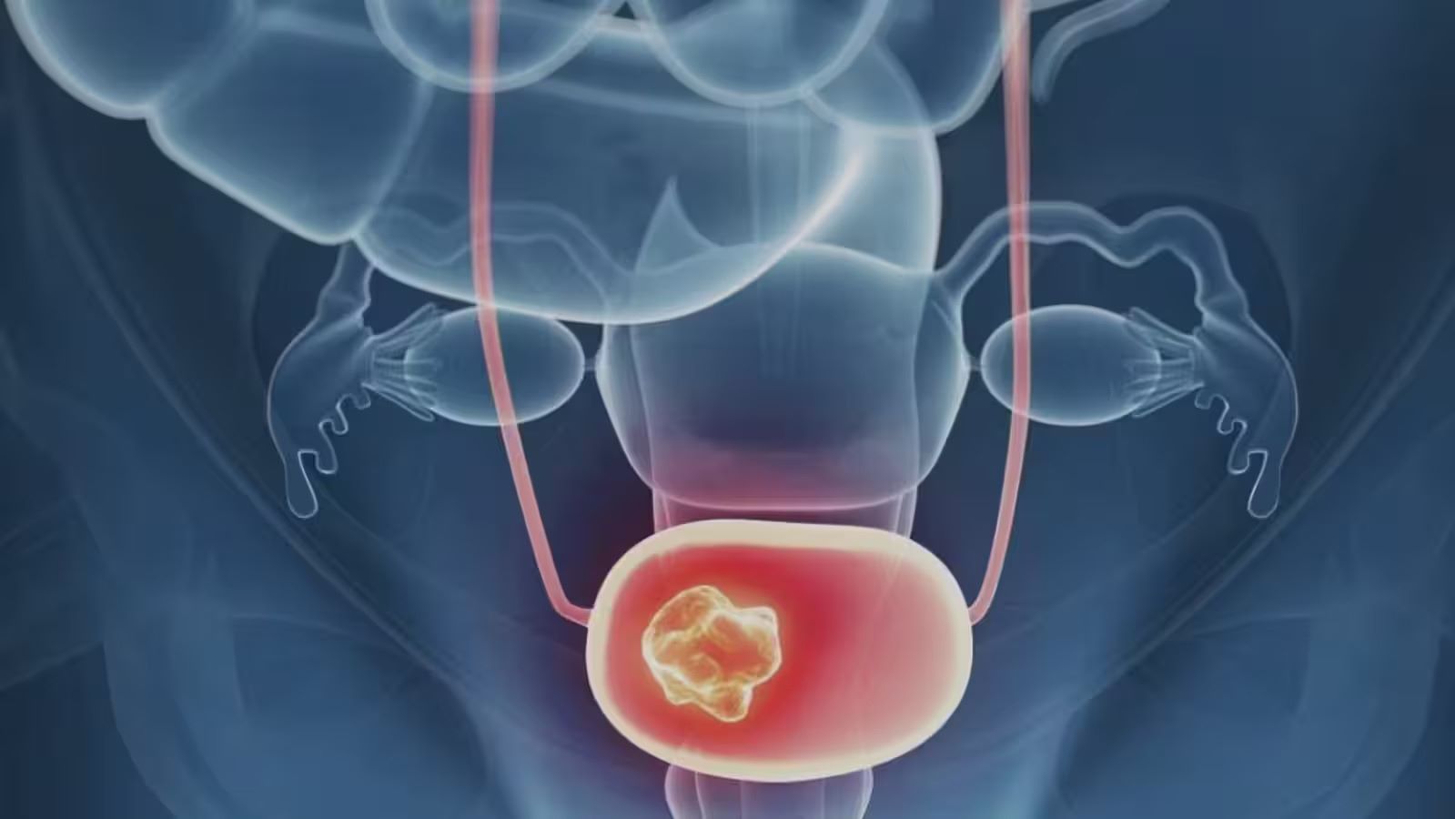 15-facts-about-bladder-cancer-prognosis