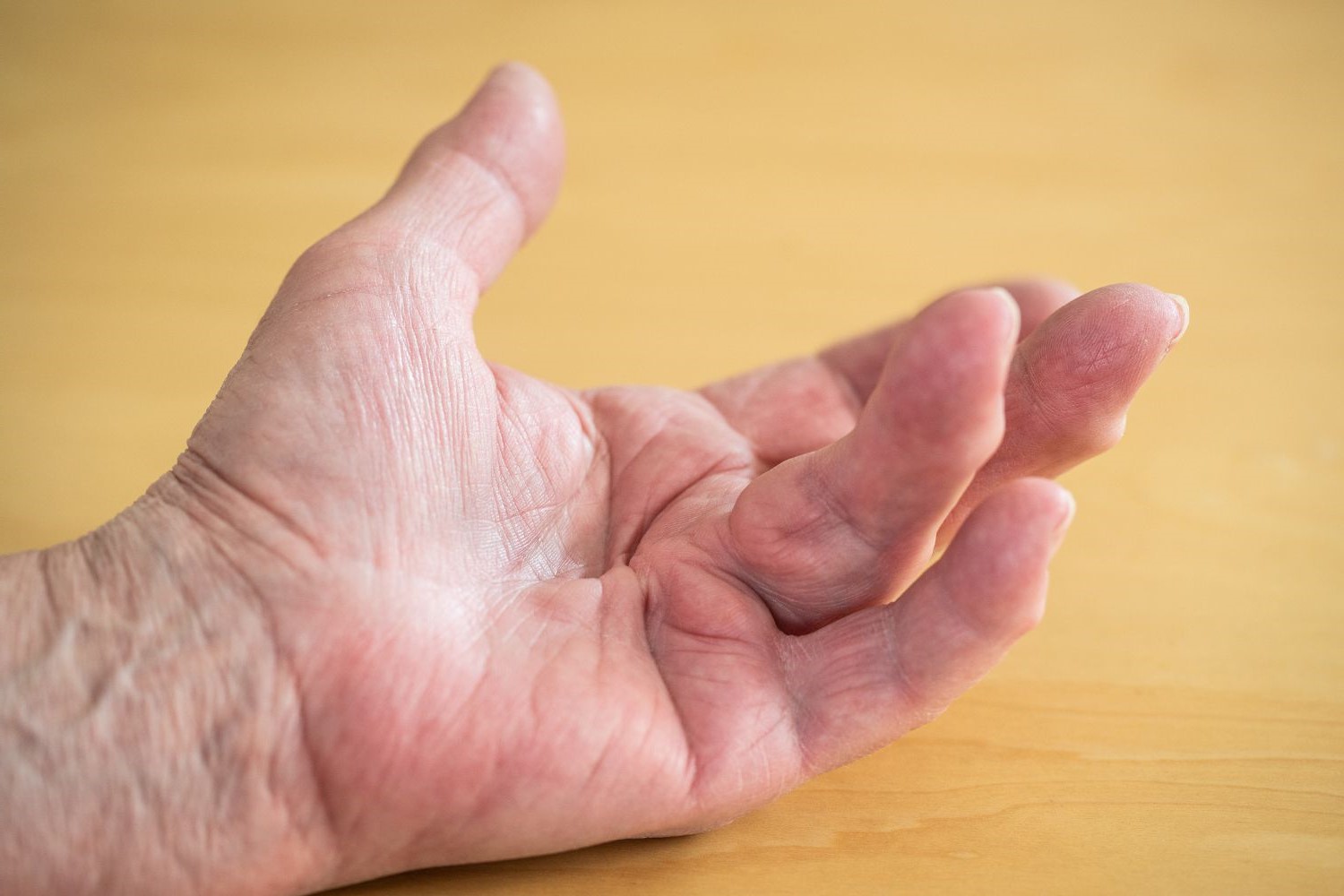 15-facts-about-dupuytrens-contracture