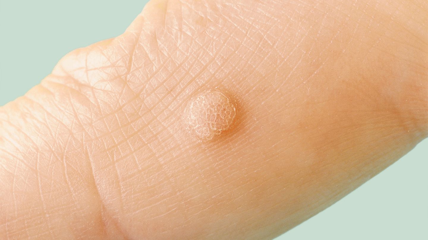 15-facts-about-genital-warts-testing