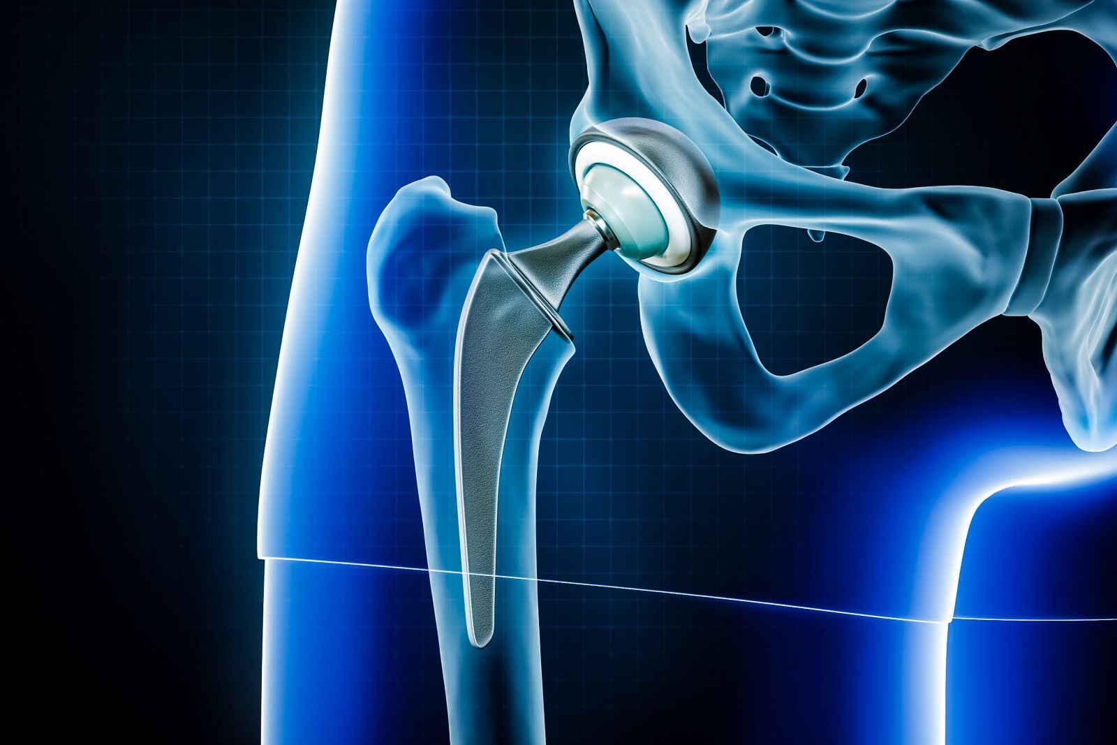15-facts-about-hip-replacement