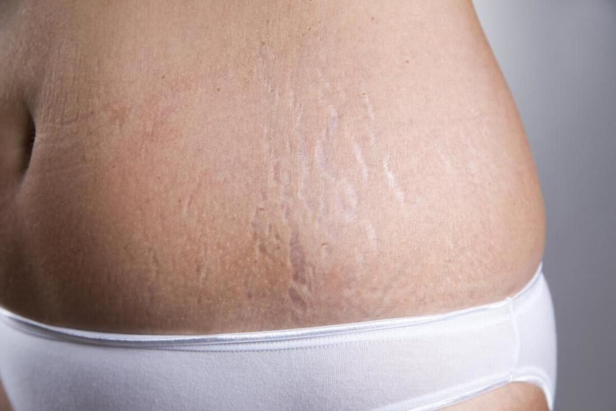 15-facts-about-how-to-get-rid-of-stretch-marks