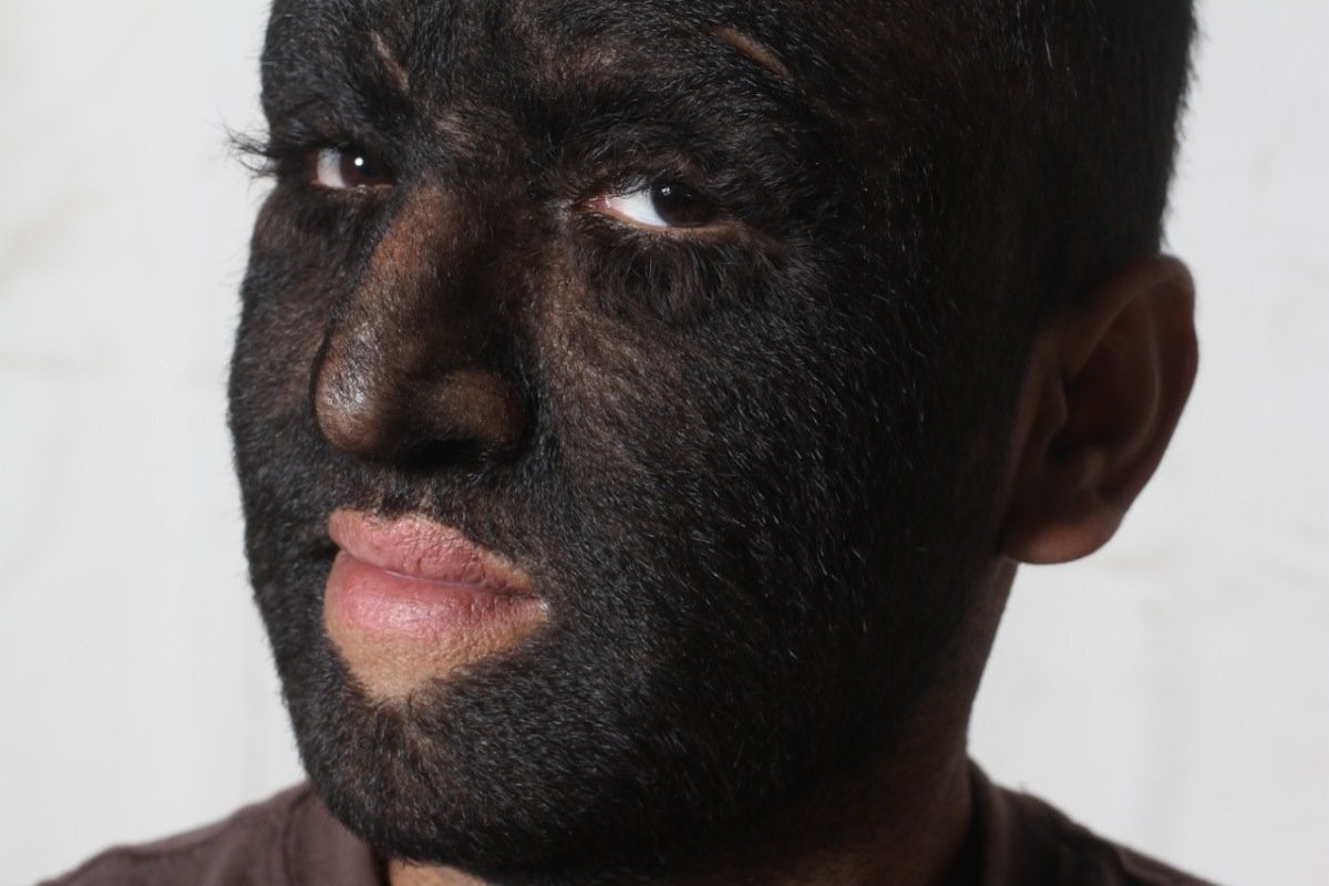 15-facts-about-hypertrichosis