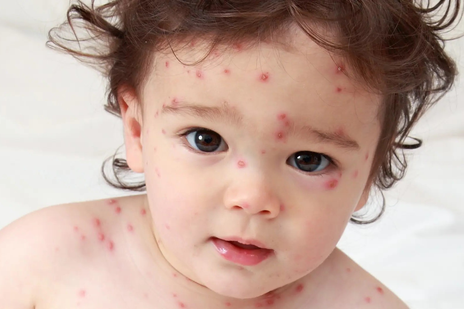 15-facts-about-is-chicken-pox-airborne