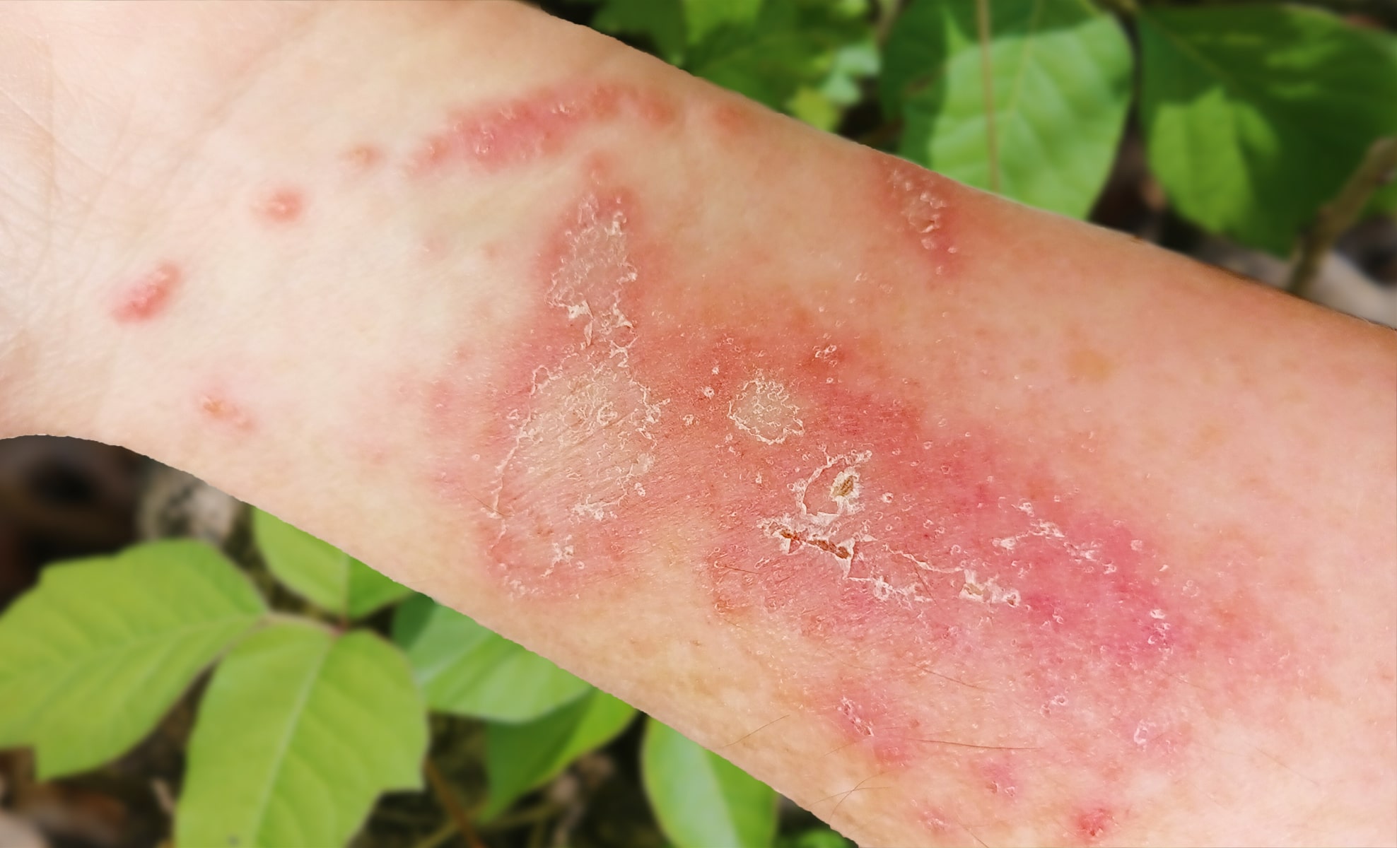 15 Facts About Poison Ivy Rash - Facts.net