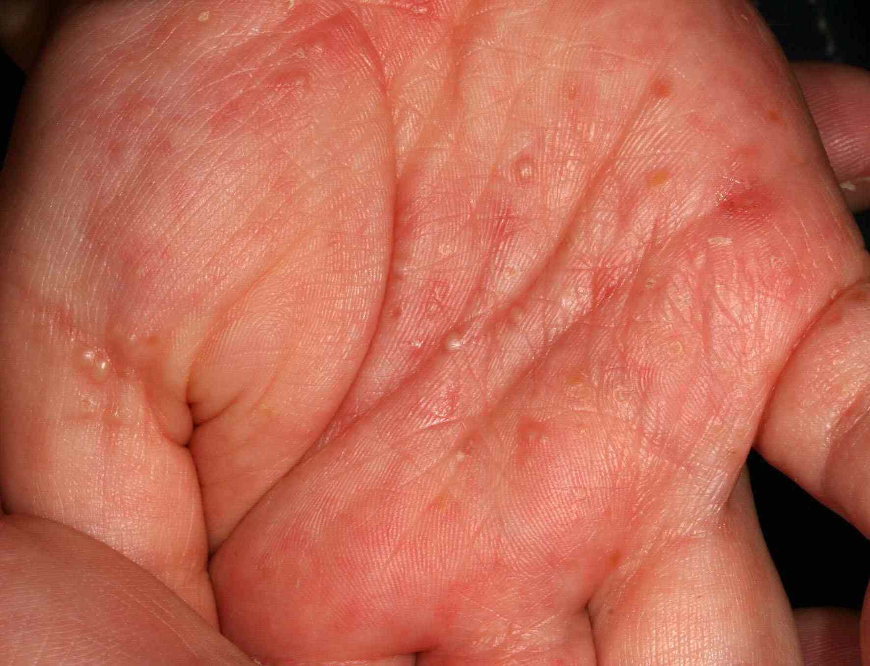 15-facts-about-scabies-testing