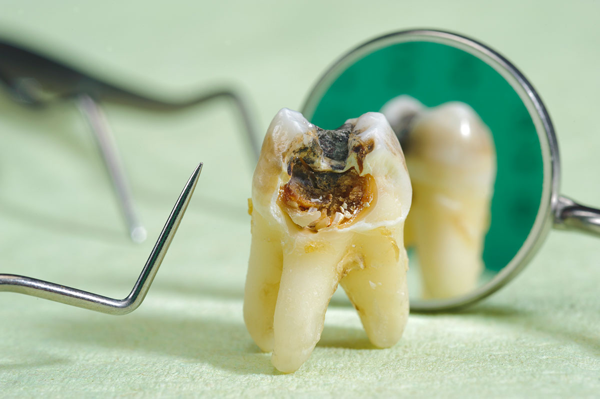 15-facts-about-tooth-decay