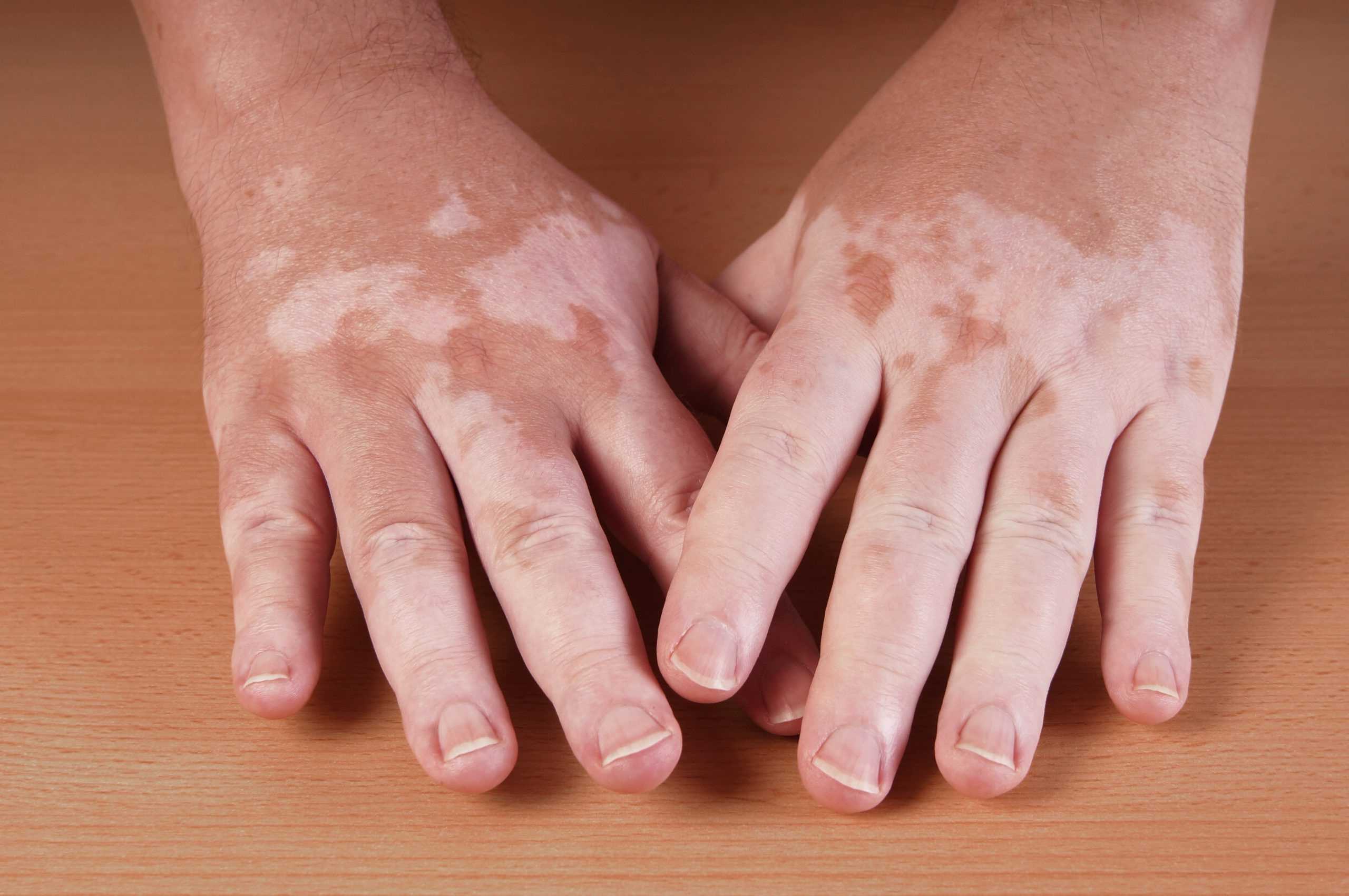 15-facts-about-vitiligo