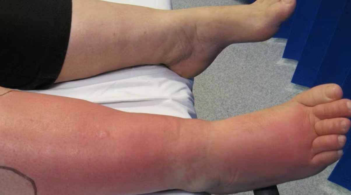 18-facts-about-cellulitis
