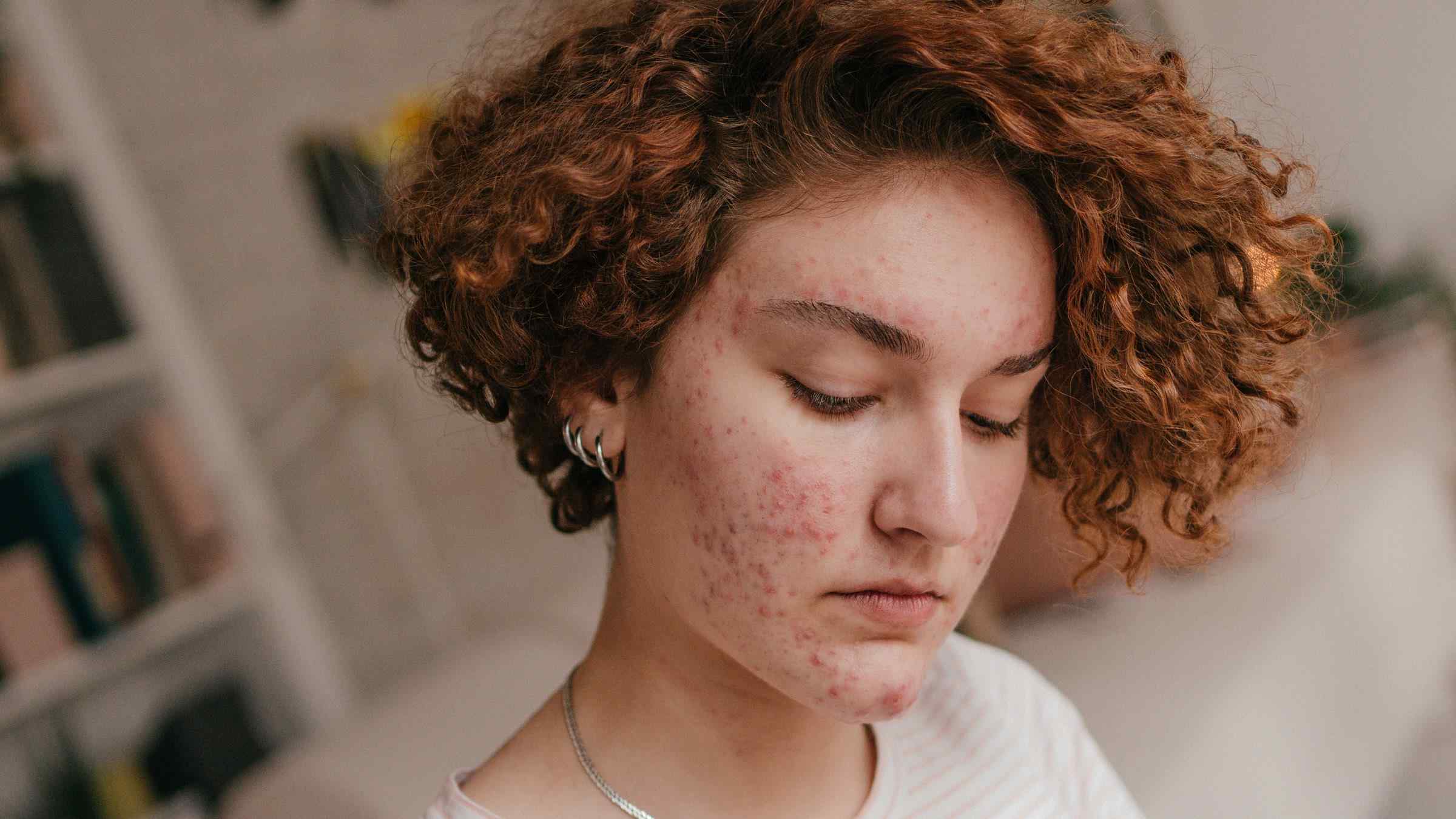20-facts-about-accutane